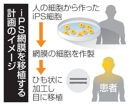 ｉＰＳ網膜を移植する計画のイメージ