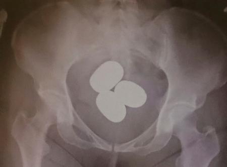 東京税関成田税関支署が公表した、香港からの旅客が体内に粉状の金を隠し密輸しようとした摘発事例（同署提供）